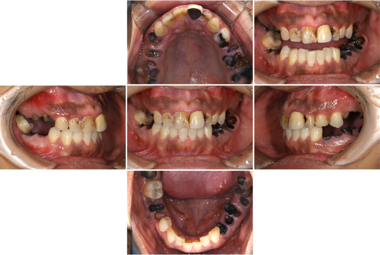 歯がボロボロになってしまった方の回復した症例（術前）