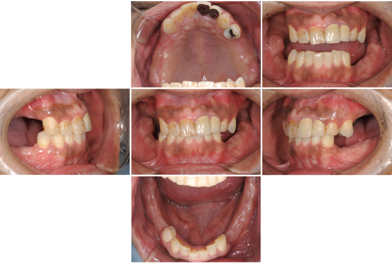 歯がボロボロになってしまった方の回復した症例（術中）