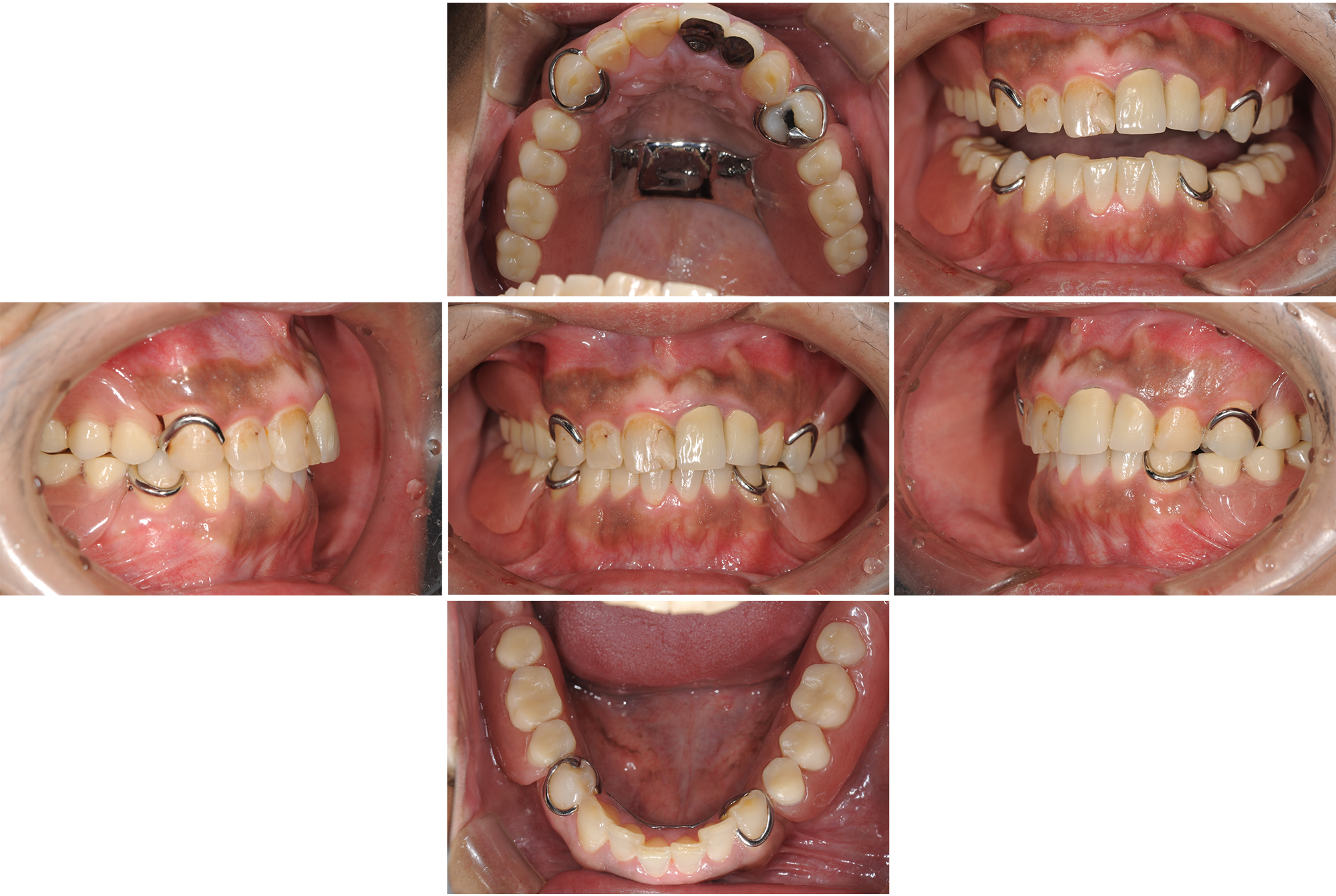歯がボロボロになってしまった方の回復した症例（術後）