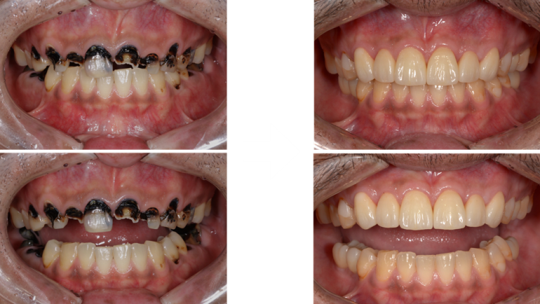 歯がボロボロになってしまった方の回復した症例