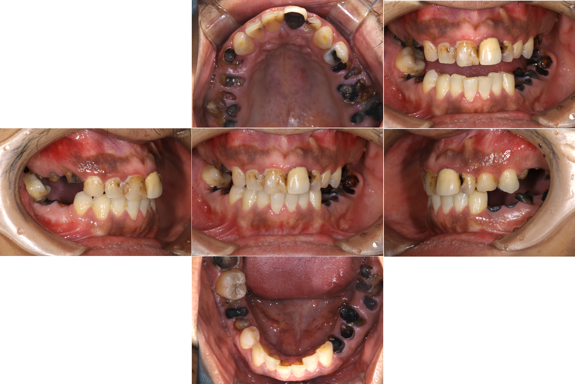 歯がボロボロCase1