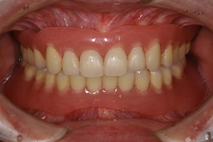 入れ歯治療の症例・Case1