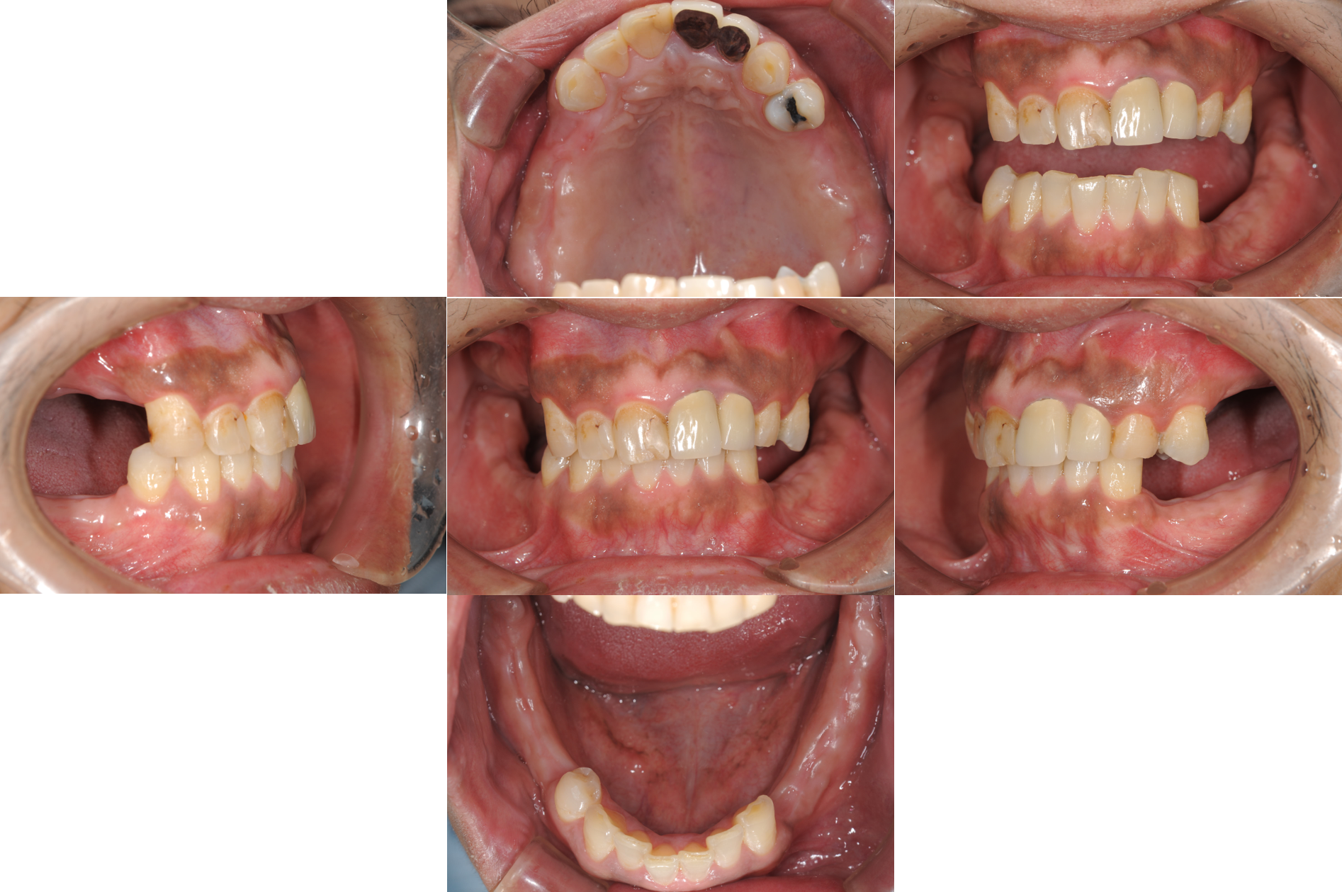 歯がボロボロCase2