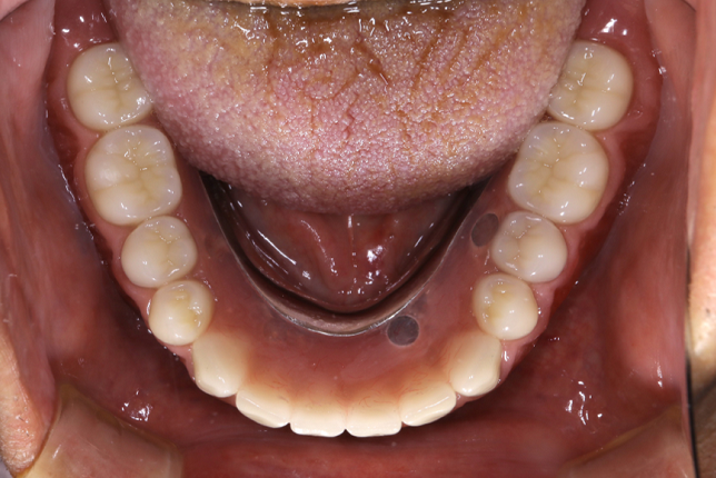 入れ歯治療の症例・Case2