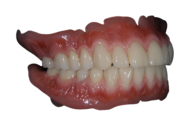 入れ歯治療の症例・Case2