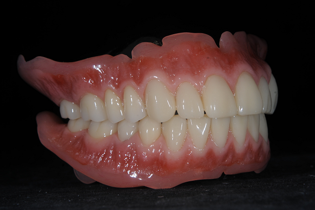 入れ歯治療の症例・Case2