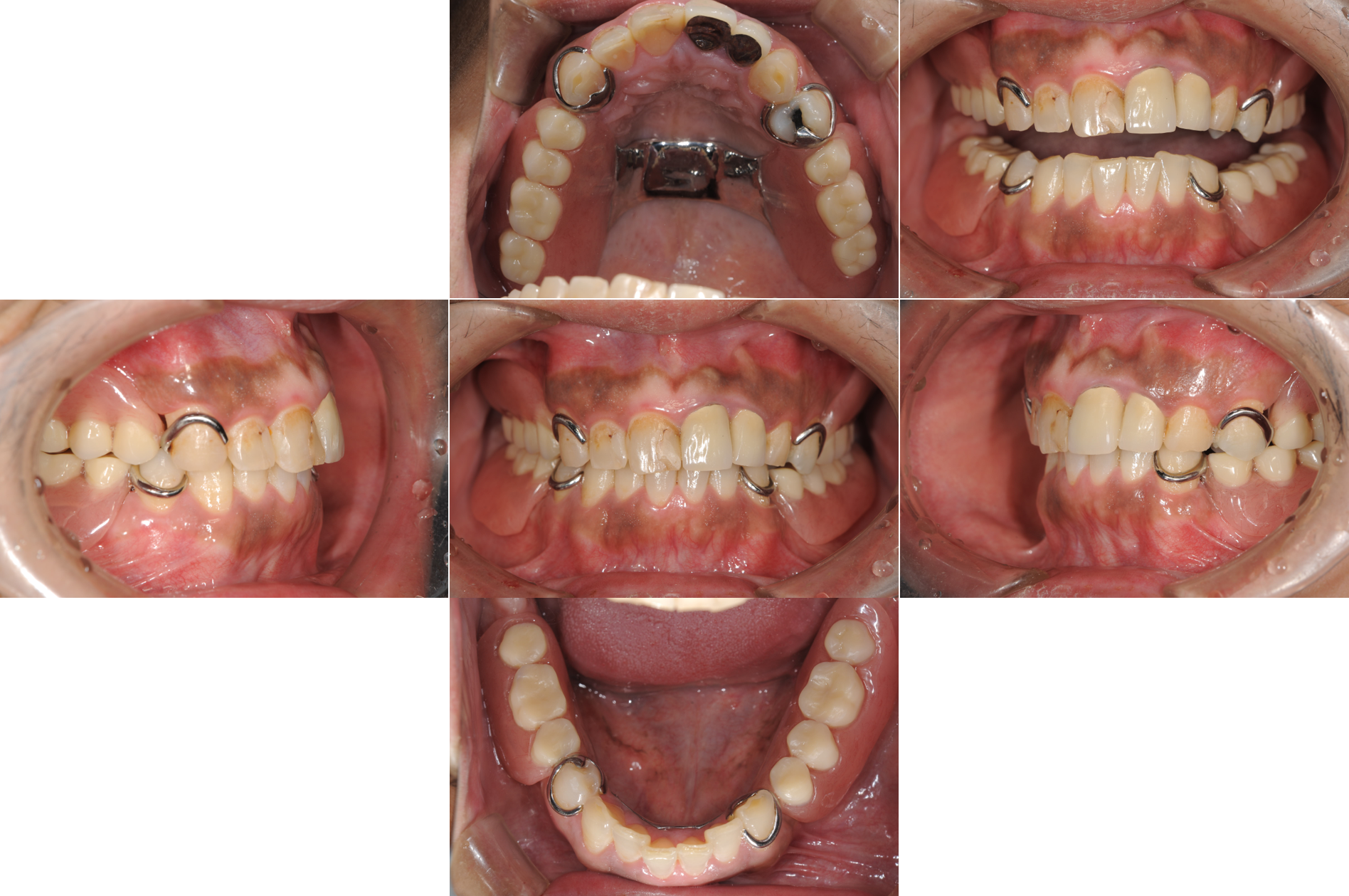 歯がボロボロCase3