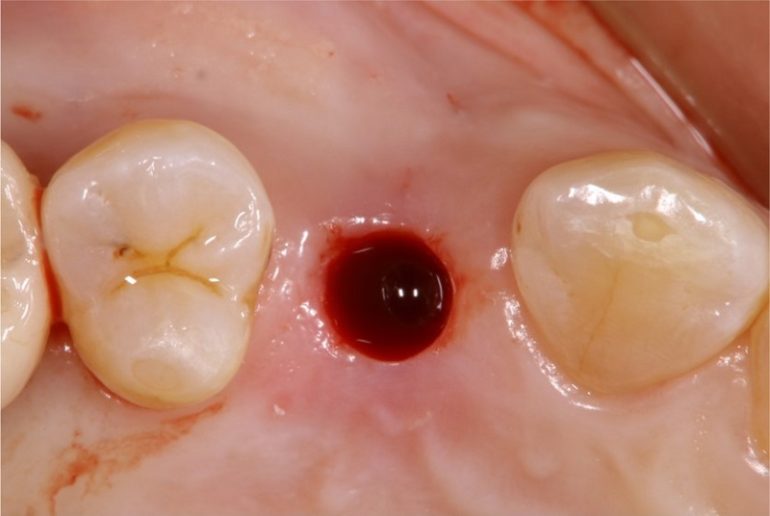 歯茎にインプラントの直径相当の穴をあける （この症例の場合はメスによる切開の必要がなかった）