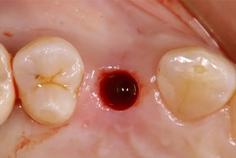 歯茎にインプラントの直径相当の穴をあける （この症例の場合は、メスによる切開の必要がなかった）