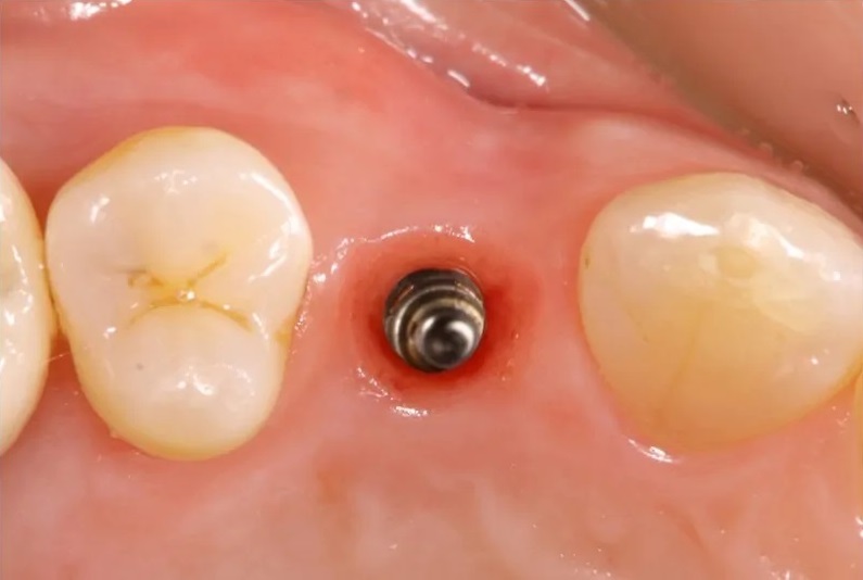 埋めたインプラント（埋めてから2ヶ月後の状態）