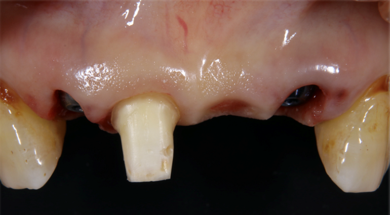 4本歯がなくなる部位の両脇２本にインプラントを埋入 （１本土台で残っている歯は後日抜歯予定）