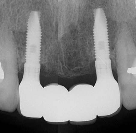 レントゲン写真 （２本のインプラントで４本の歯を作製）