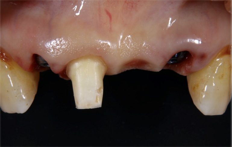 ４本歯がなくなる部位の両脇２本にインプラントを埋入（１本土台で残っている歯は後日抜歯予定）