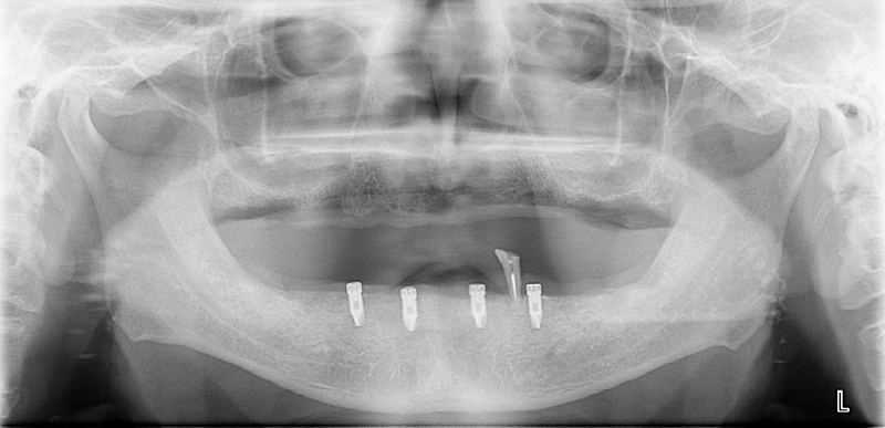 インプラントを必要数埋入します。 インプラントが使用できるようになるまでは、既存の仮入れ歯を使用して頂きます。