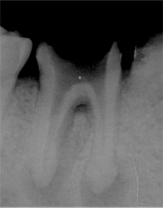 ②被せ物を外し、さらに歯の内部に詰められている 汚染された物質を除去 徹底的に歯の内部を清掃・消毒