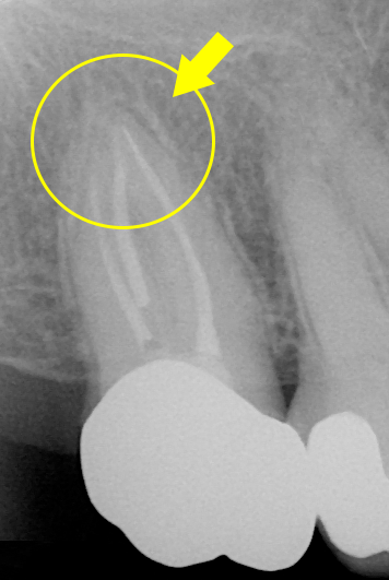 感染根管・術後5年