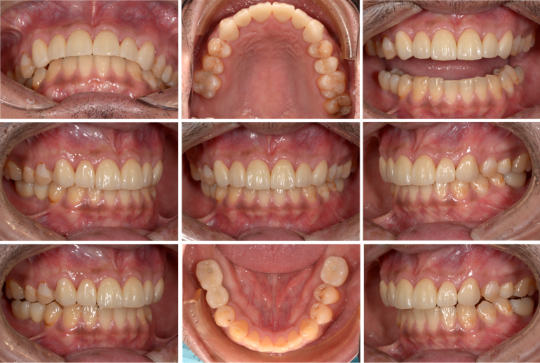 歯がボロボロになってしまった方の回復した症例