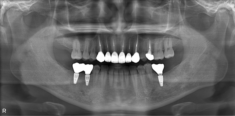 歯がボロボロになってしまった方の回復した症例