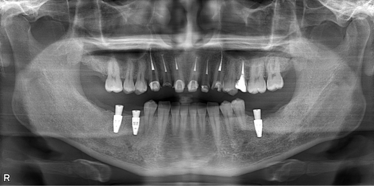 歯がボロボロになってしまった方の回復した症例