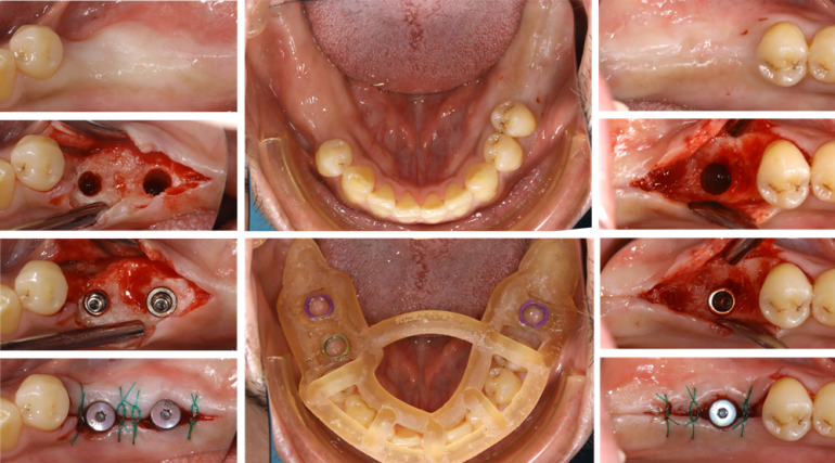 歯がボロボロになってしまった方の回復した症例