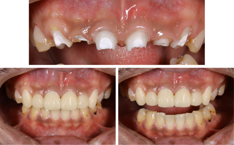 歯がボロボロになってしまった方の回復した症例